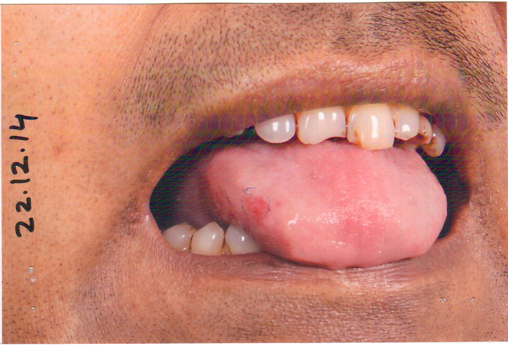 Rajesh-gupta-Tongue-cancer-0006